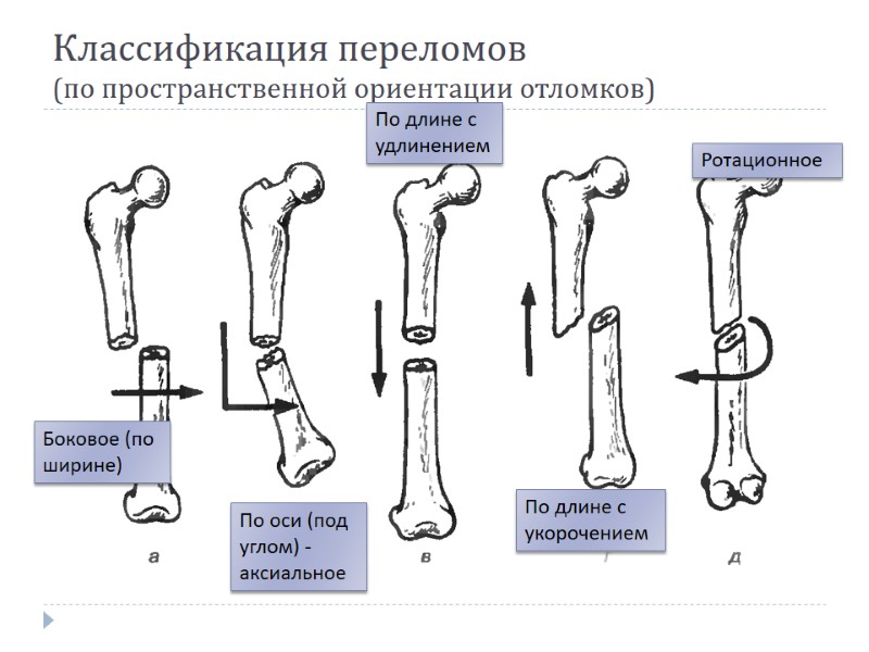 Классификация переломов  (по пространственной ориентации отломков) Боковое (по ширине) По оси (под углом)